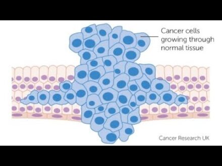 Cancer Research into Interstitium which is a New Found Human Body Organ